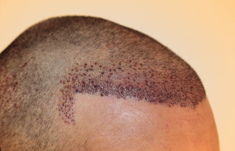 Mengenal Hair Transplant dan Tekniknya